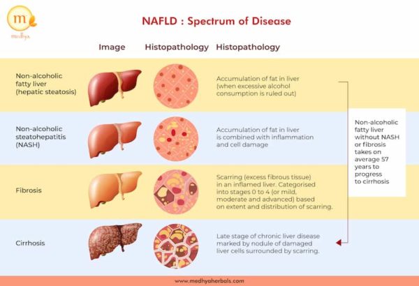 How to Reverse Fatty Liver? 8 Natural Ways to Make Your How to Reverse Fatty Liver? 8 Natural Ways to Make Your