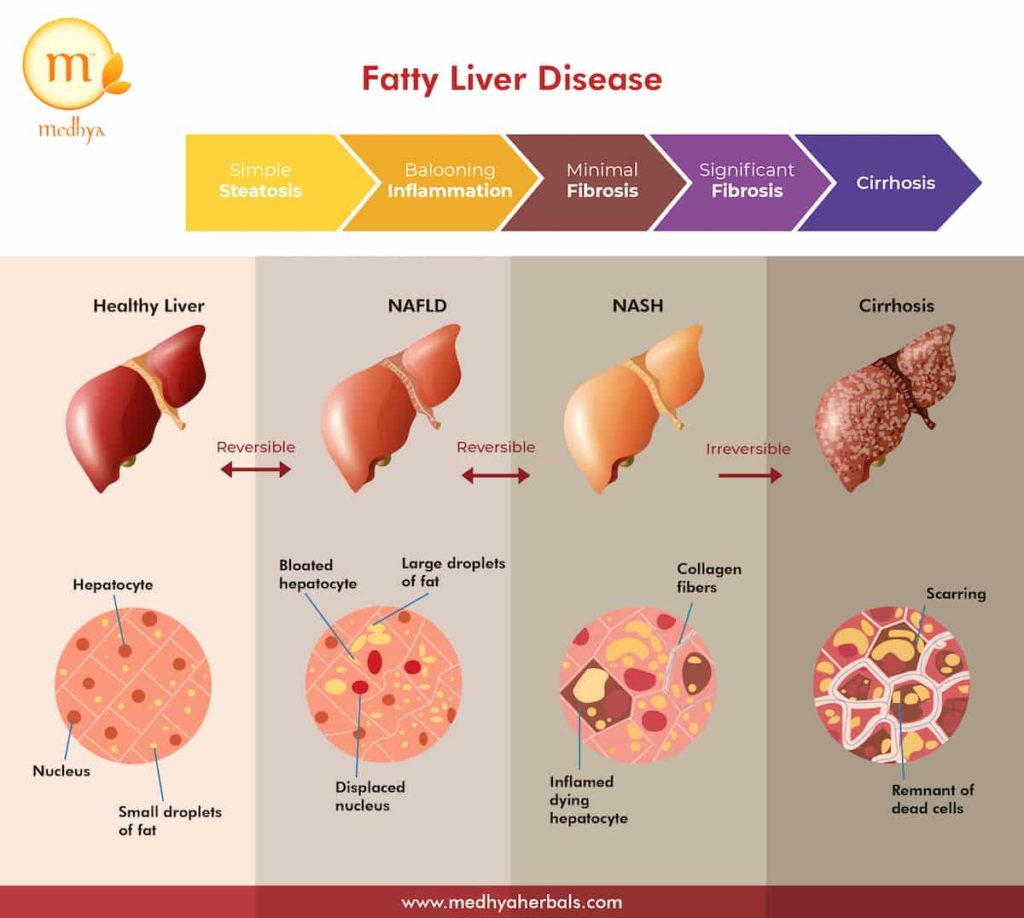 Fatty Liver Disease Progression and Symptoms