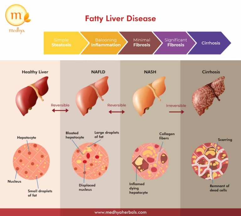 Difference Between Mild Fatty Liver And Grade 1 Fatty Liver