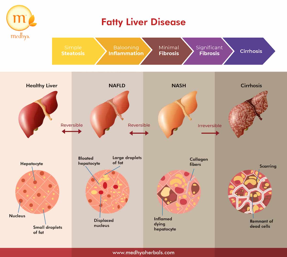 Fatty Liver Disease-min