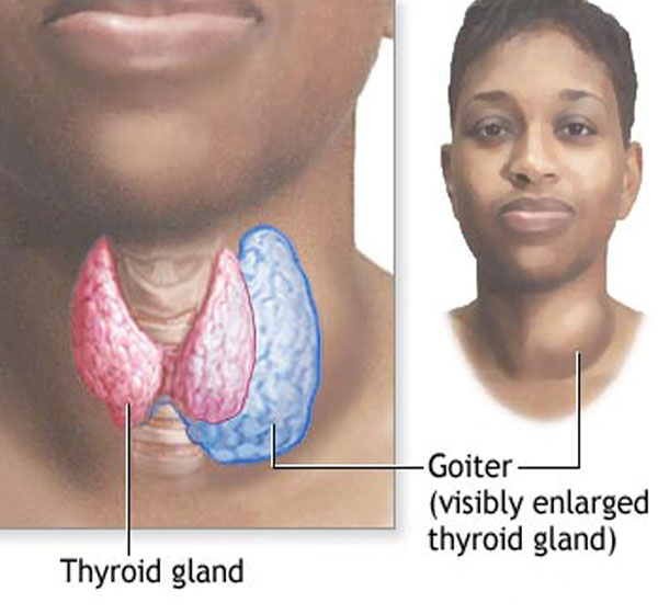 thyroid-goiter-hypothyroidism