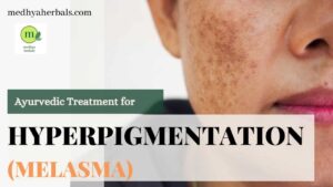 Ayurvedic Treatment for Hyperpigmentation Melasma