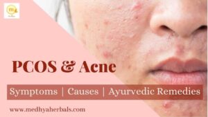 pcos acne ayurveda diet-min
