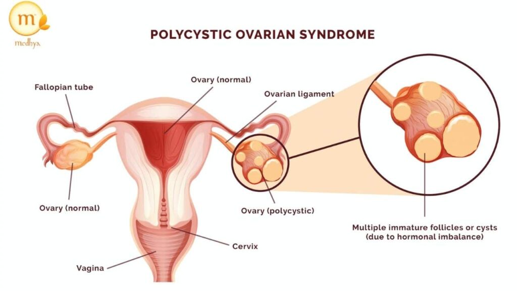 pcos ayurveda