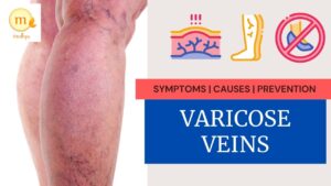ayurvedic treatment for varicose veins