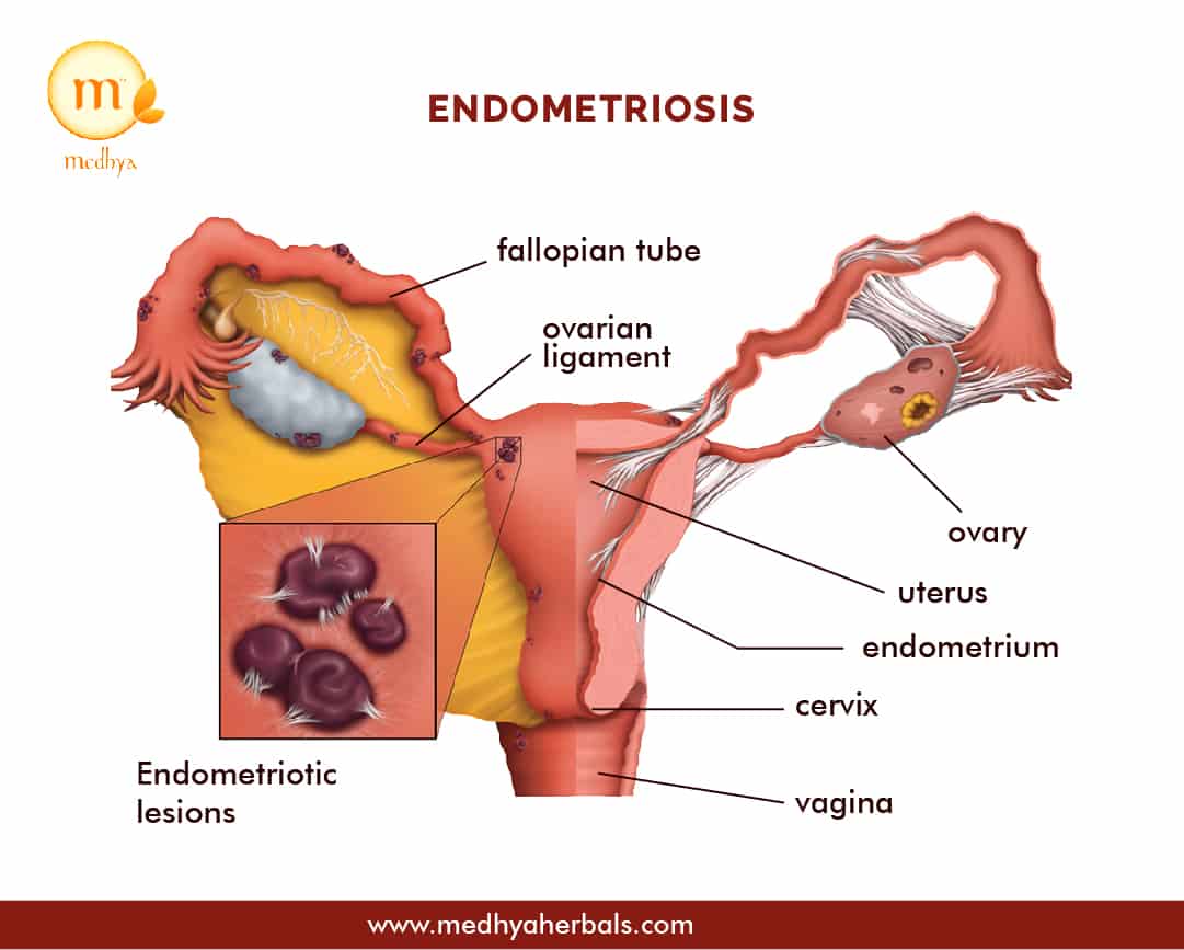 Endometriosis