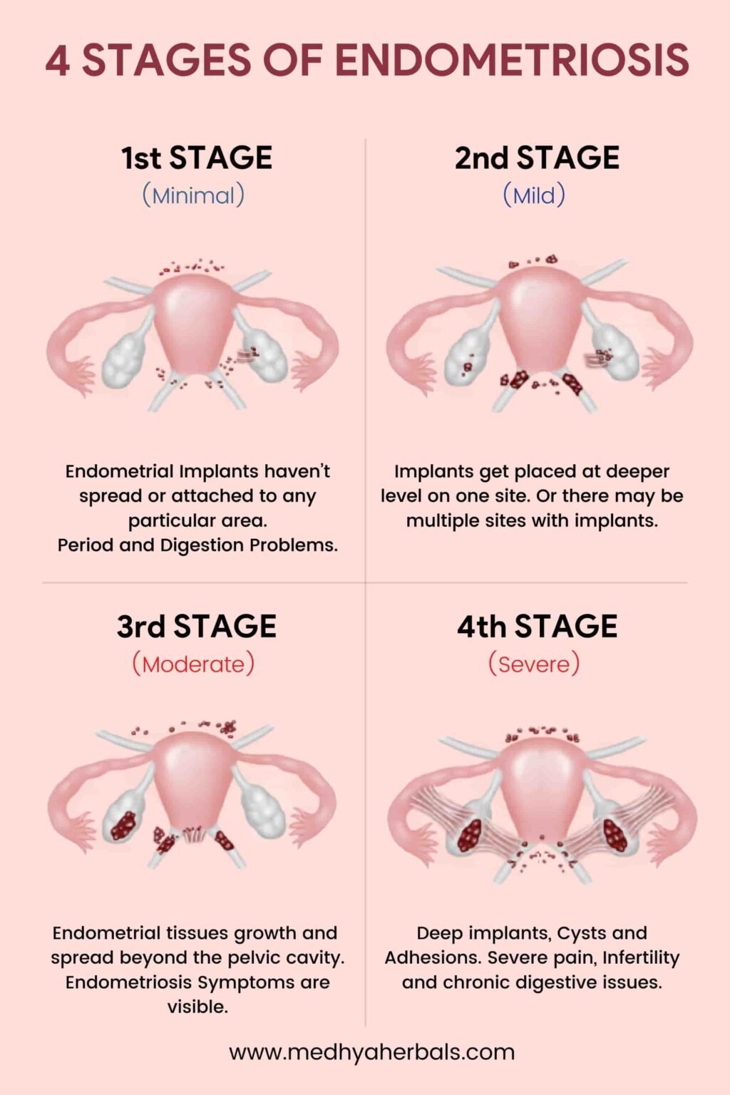 Endometriosis Symptoms 5 Early Signs You Shouldnt Ignore