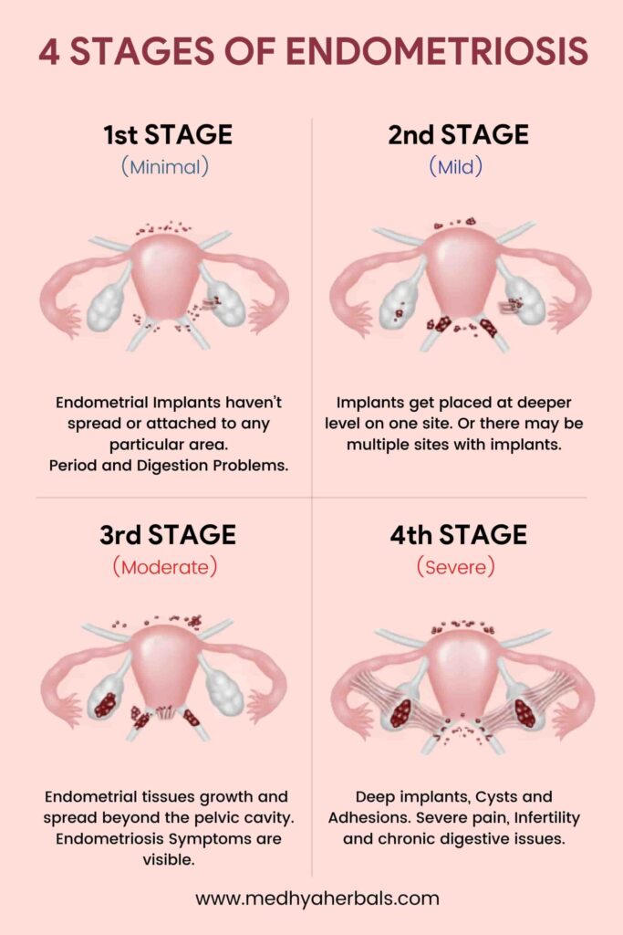 Endometriosis Chart