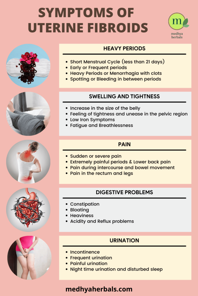 Uterine Fibroids - Fibroid Symptoms