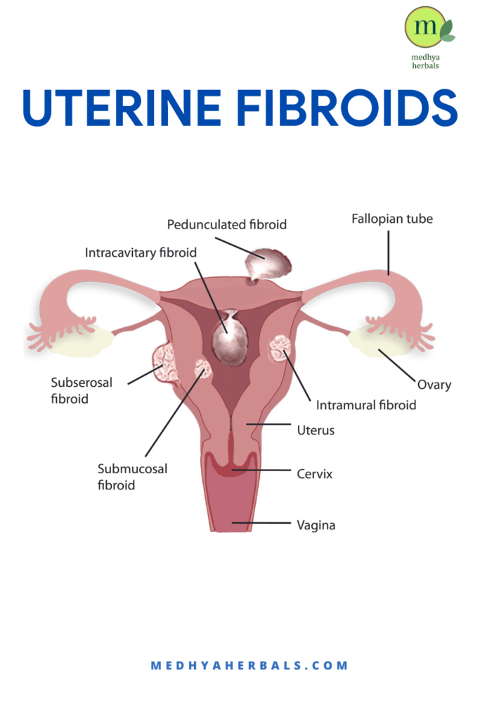 Types of Uterine Fibroids