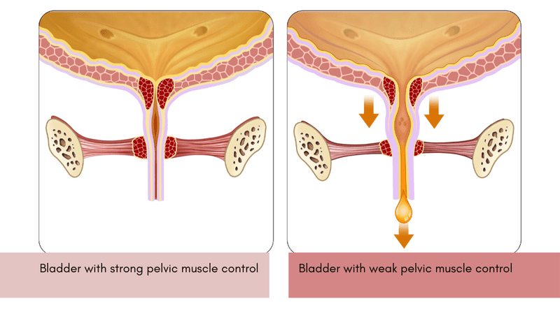 Urinary Incontinence