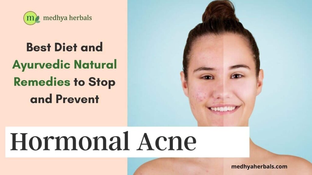 how to prevent hormonal acne diet and ayurvedic remedies-min
