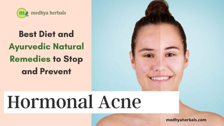 Ayurvedic Doctors Guide To Hormonal Acne Natural Treatment