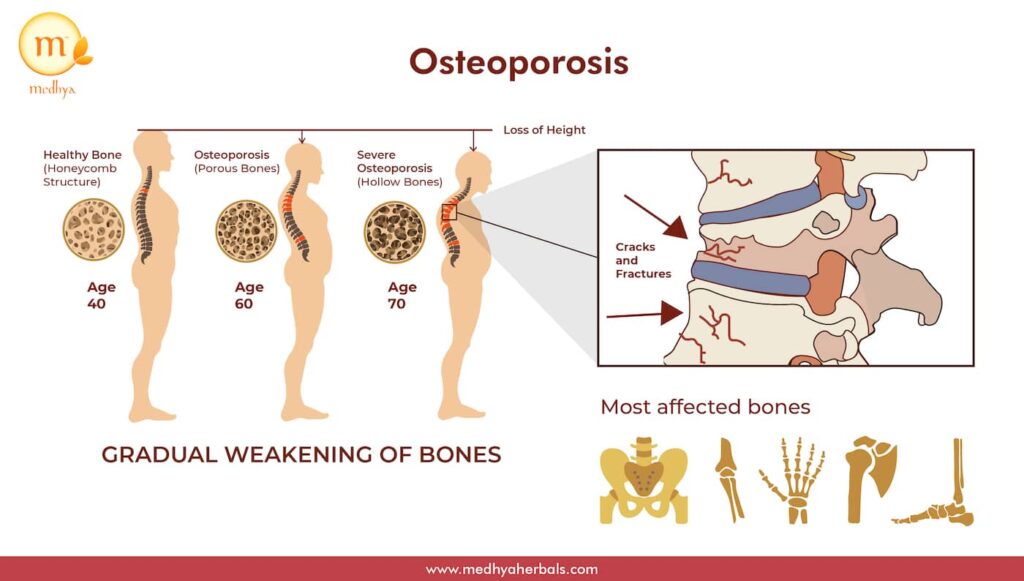 Bone Density Loss and Osteoporosis