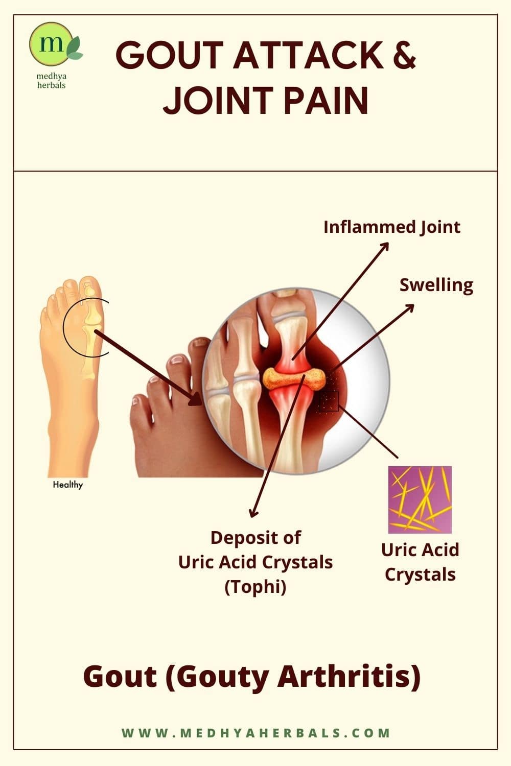 Gout, High Uric Acid, Joint Pain 5 Ayurvedic Ways for Natural Relief