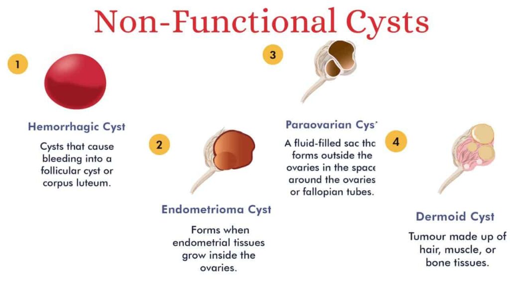Non functional ovary cysts-min