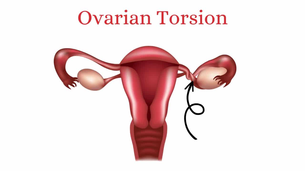 Ovarian Cyst Treatment In Ayurveda A Doctor S Guide