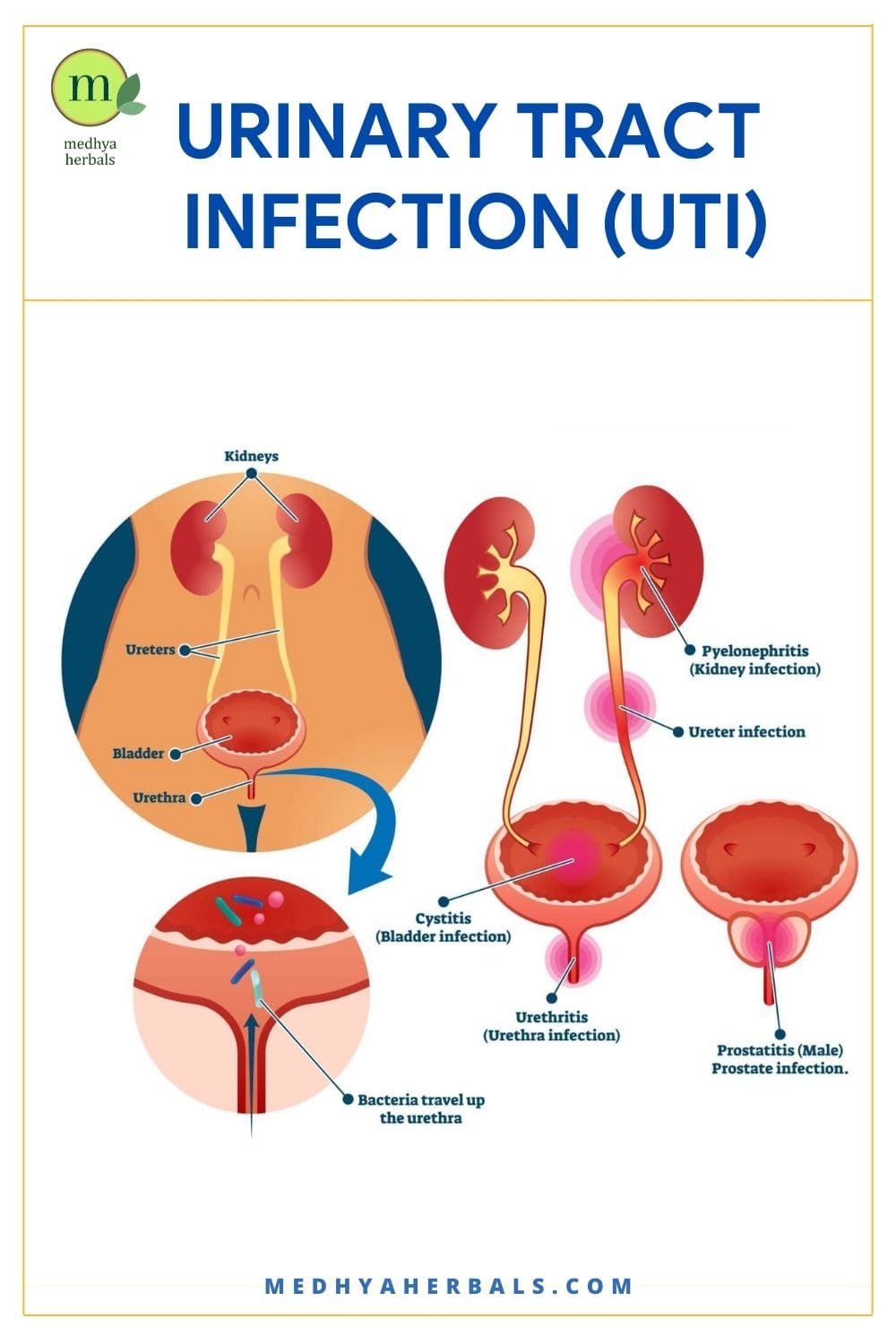 Urinary Tract Infection (UTI) | Ayurvedic Treatment, Diet, Natural Remedies