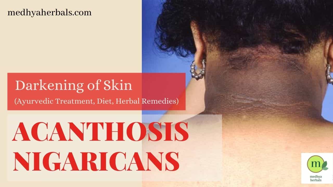 Acanthosis Nigricans- Ayurvedic Treatment for Black Neck-Dark Neck