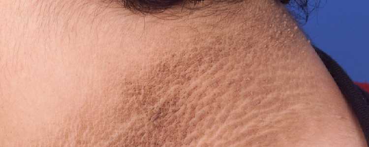 Acanthosis Nigricans- Ayurvedic Treatment