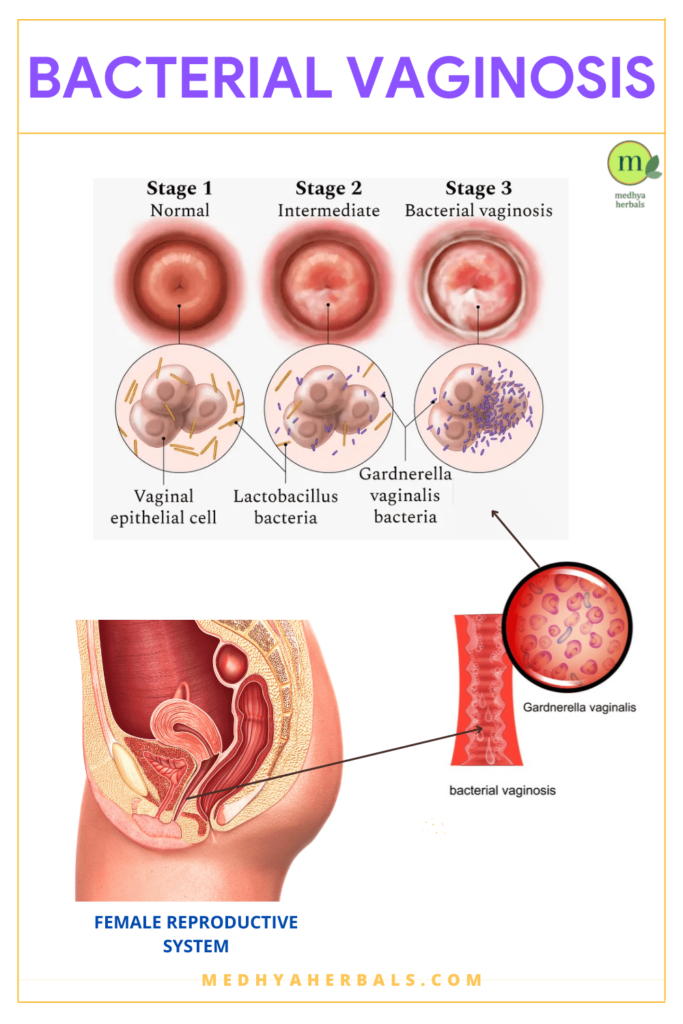 Bacterial Vaginosis Infection