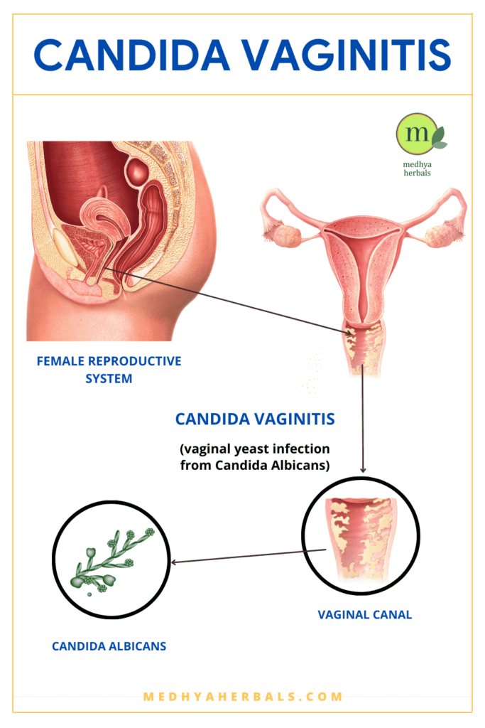 Candida Vaginitis - Vaginal Yeast Infections