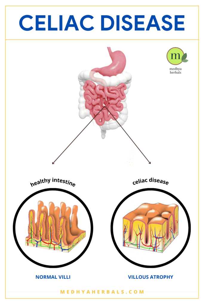 How does Celiac Disease affect intestine?