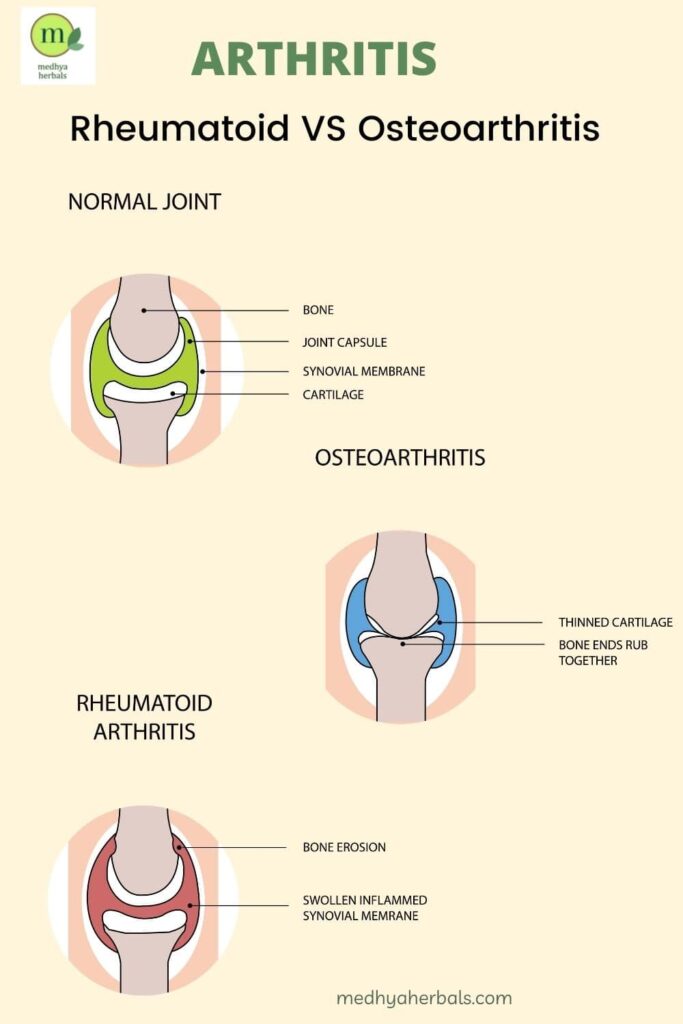Rheumatoid Arthritis Osteoarthritis Joint Health-min