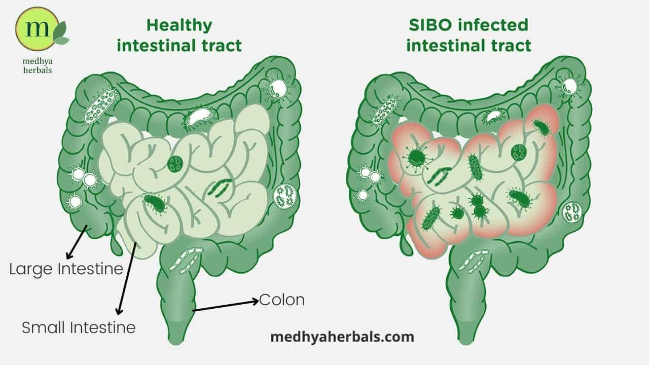 Sibo doctors near me