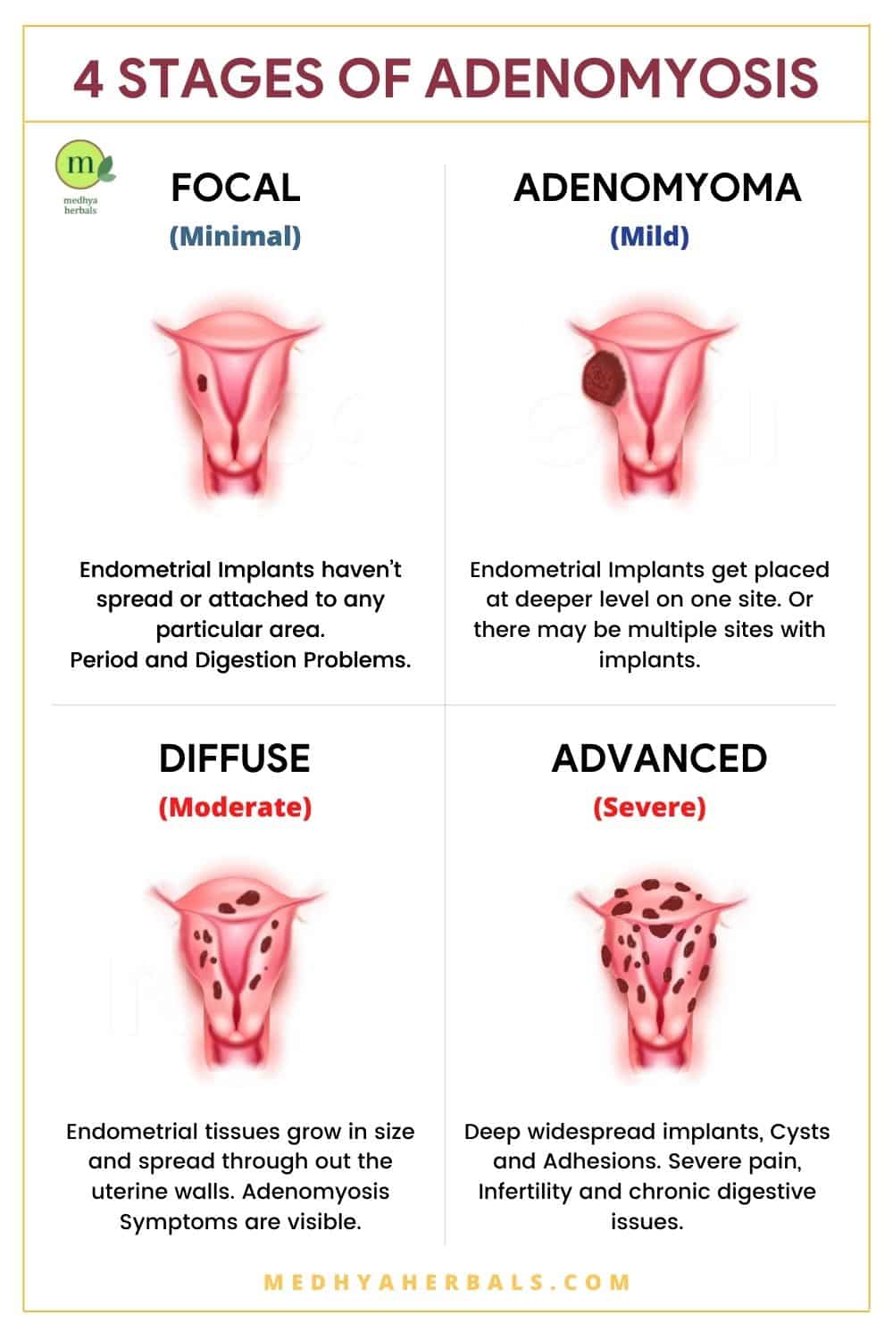 adenomyosis-bulky-uterus-ayurvedic-natural-treatment