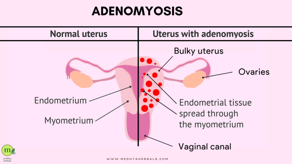 Ayurvedic Treatment for Adenomyosis-min