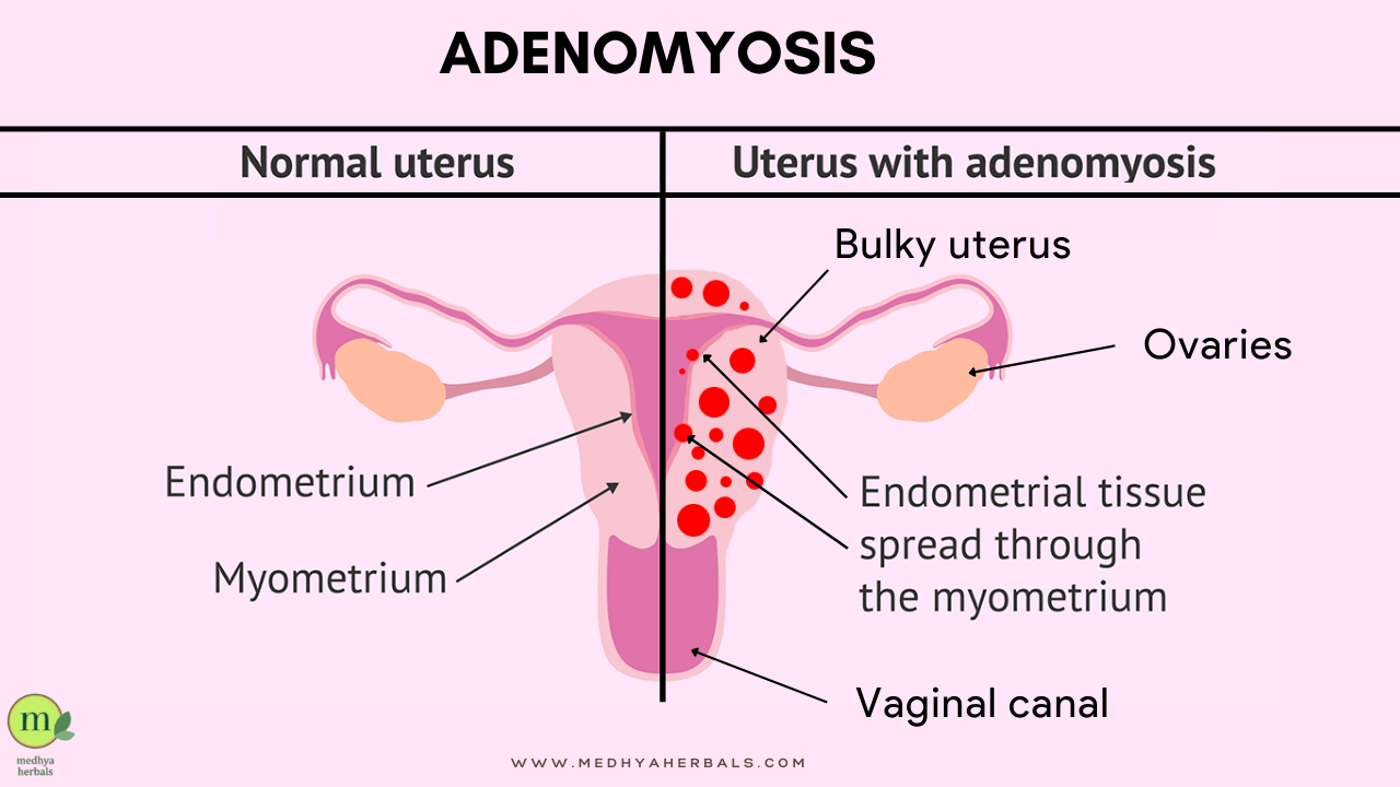 Does Menopause Cure Adenomyosis At Sarah Dobell Blog