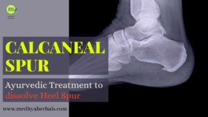 Ayurvedic Treatment to Dissolve Heel Spur (Calcaneal spur) Naturally-min
