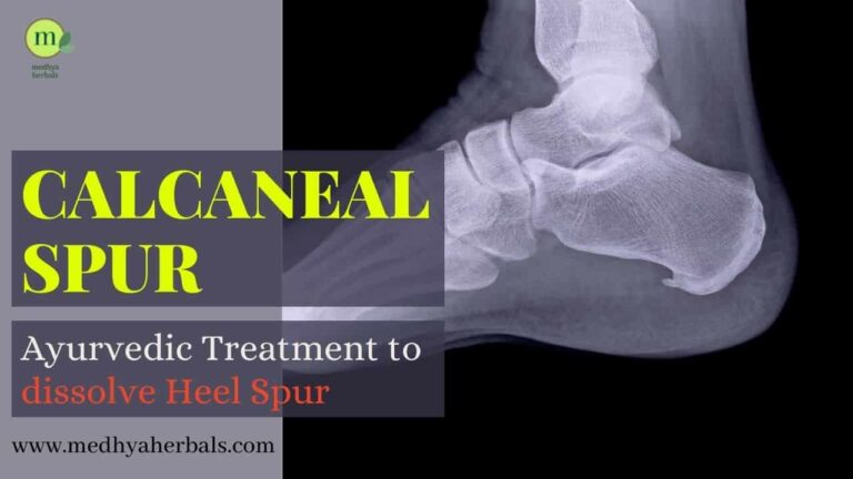 Heel Spur Treatment: The Best Ayurvedic Remedies For Pain