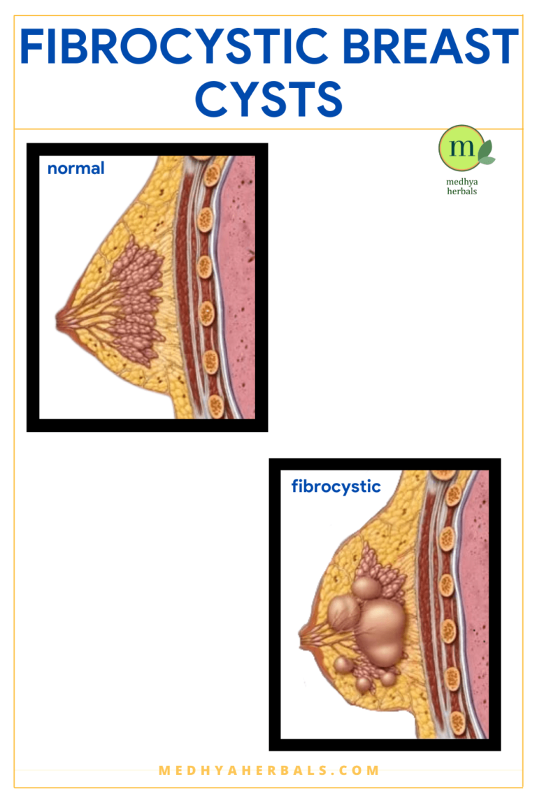 Breast Cysts Natural Treatment: The Best Ayurvedic Remedies