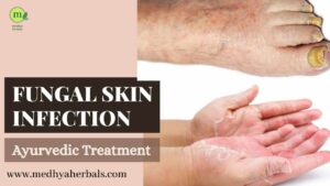 Fungal Skin Infection Treatment Ayurveda-min