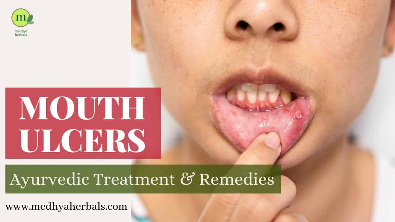 Mouth Ulcers Treatment Ayurvedic Home Remedies-min