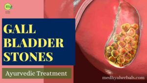 Remove Gallstones Ayurvedic Treatment-min
