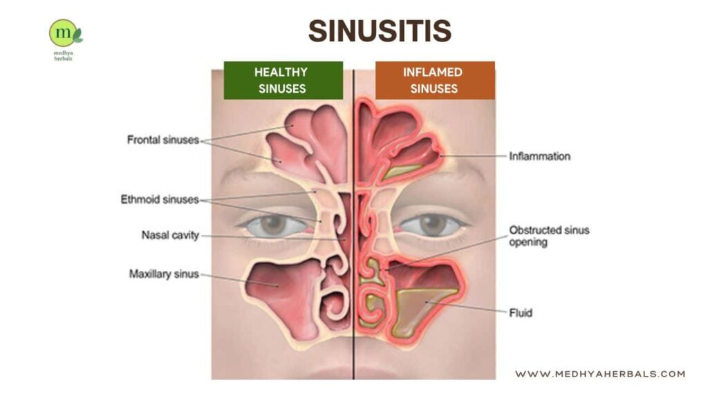 Chronic Sinusitis