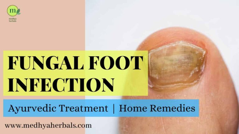 Athlete’s Foot Fungus Treatment: Easy Ayurvedic Ways To Cure Infection