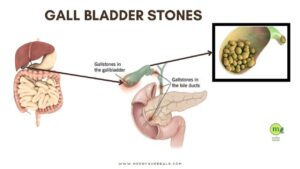 4 Amazing Ayurvedic Ways For Gallstones Treatment Without Surgery