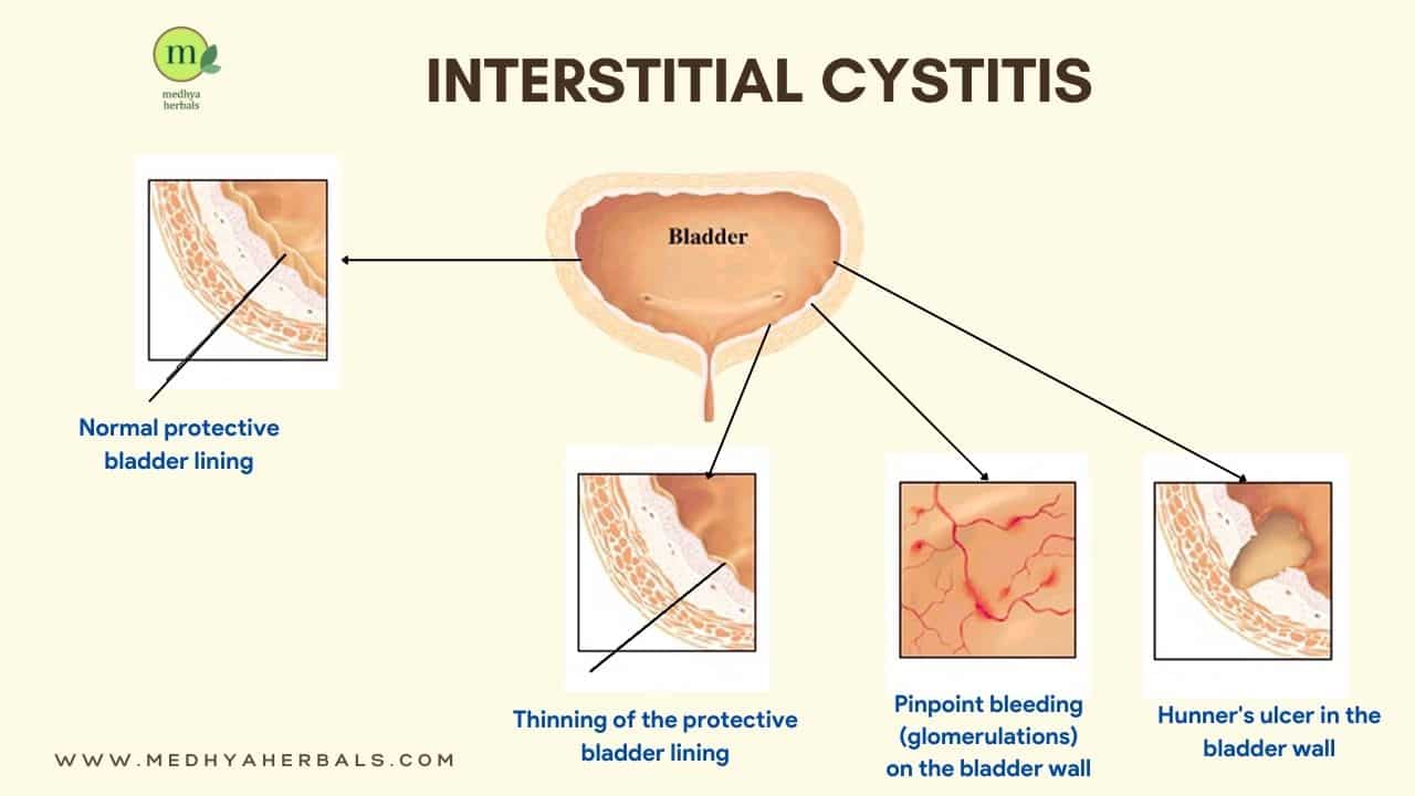 Interstitial Cystitis Treatment The Best Ayurvedic Remedies interstitial-cystitis-treatment-the-best-ayurvedic-remedies