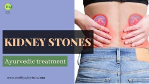 Kidney Stones Ayurvedic Treatment-min