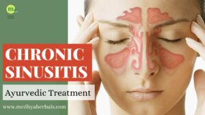 Sinusitis Ayurvedic Treatment-min