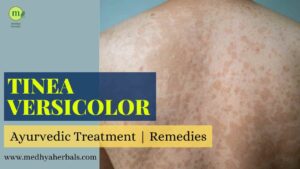 Tinea Versicolor: Complete Ayurvedic Treatment that will Cure Fast