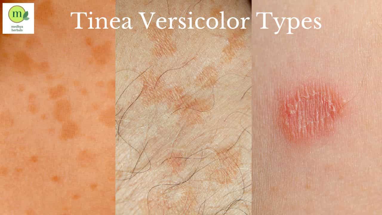 Tinea Versicolor Complete Ayurvedic Treatment That Will Cure Fast