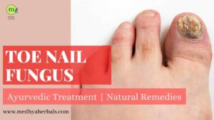Toe Nail Fungal Infection Ayurvedic Treatment-min