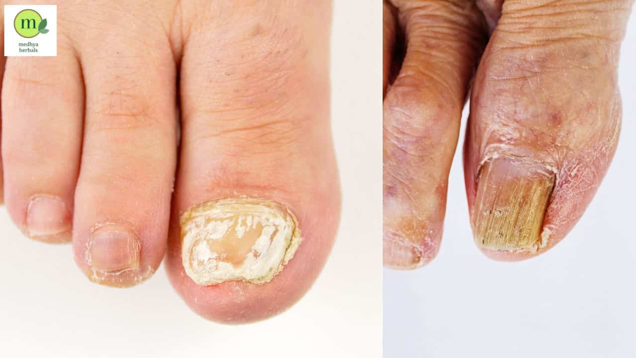 The Best Ayurvedic Remedies for ToeNail Fungus Treatment