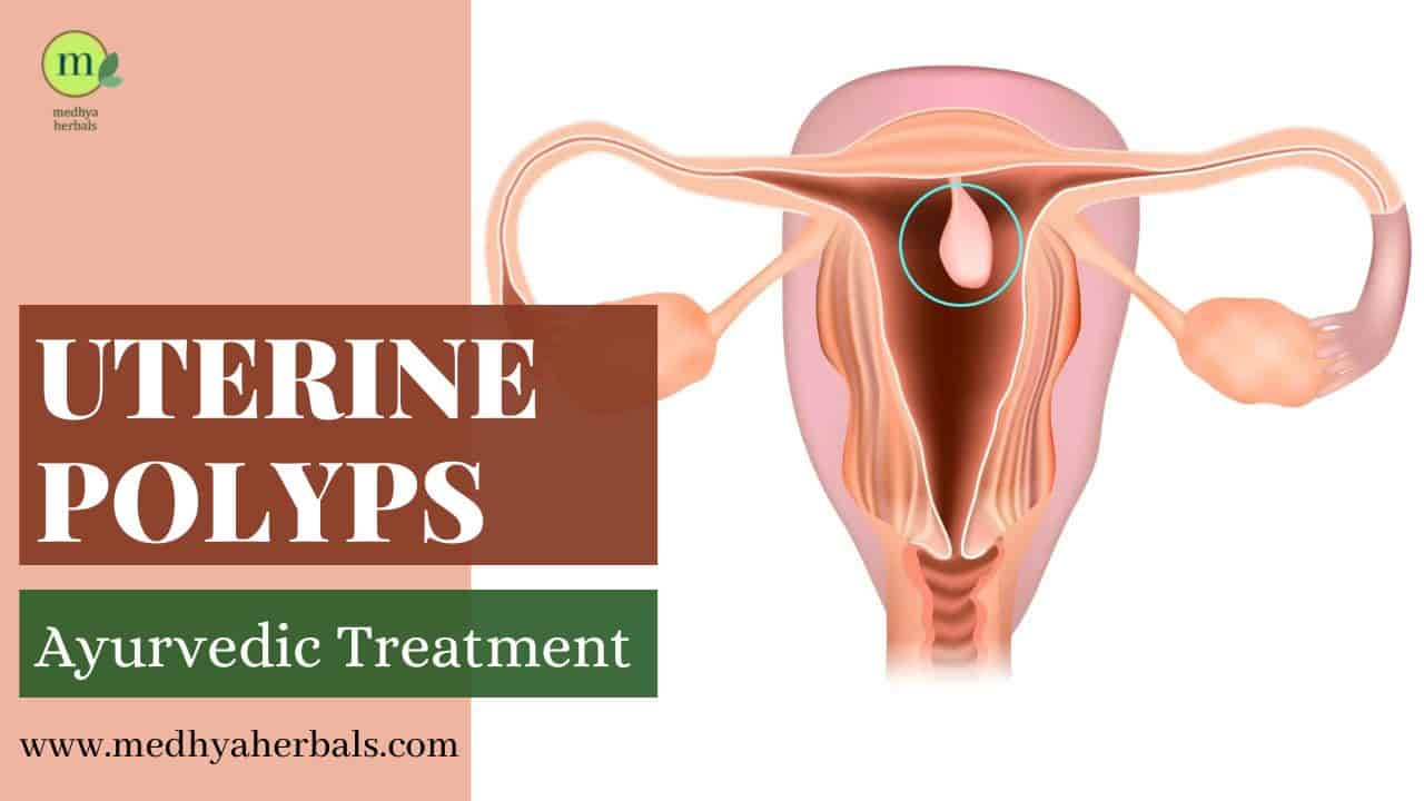 Uterine Polyps Ayurvedic Treatment-min