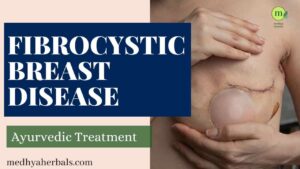 Fibrocystic Breast Disease Ayurvedic Treatment-min